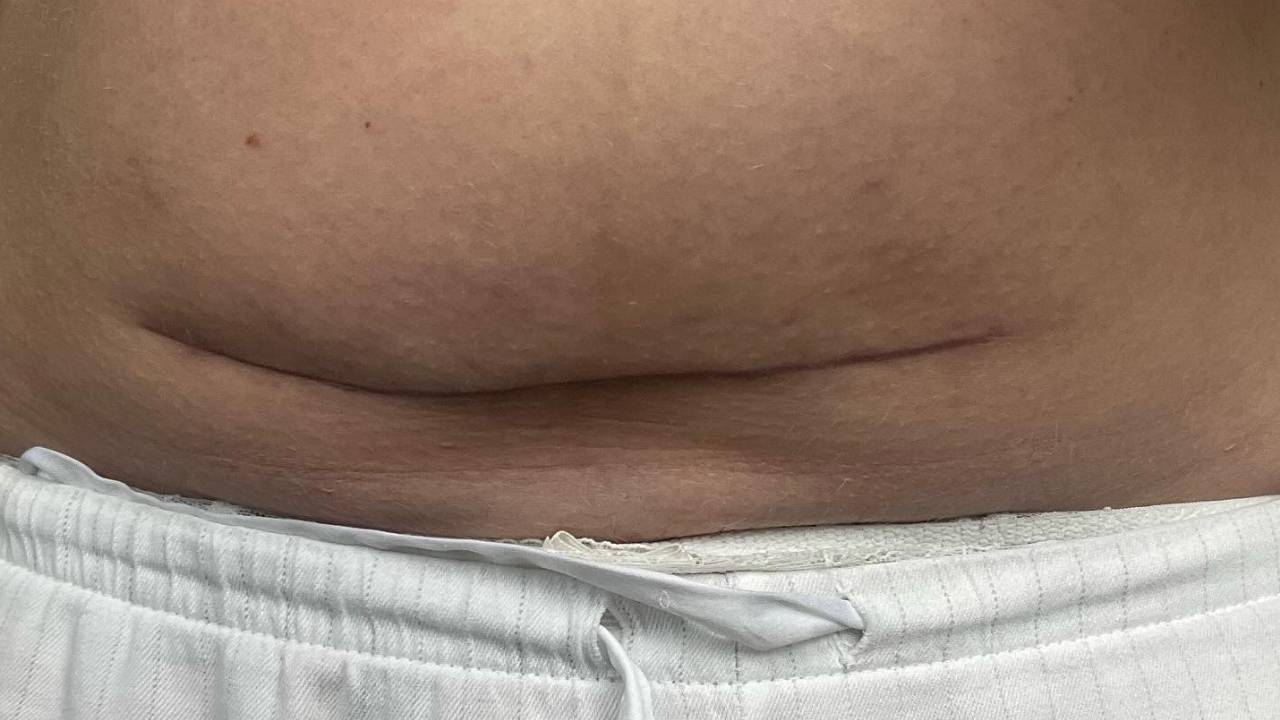 Postpartum C-section shelf and abdominal overhang after surgery